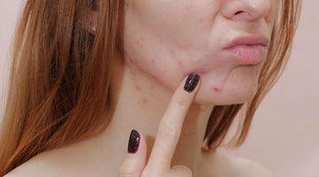 How To Treat Blind Pimples and Prevent Future Breakouts