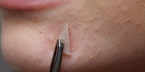 Do Pimple Patches Work Find Out the Science Behind Them