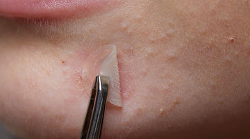 Do Pimple Patches Work Find Out the Science Behind Them