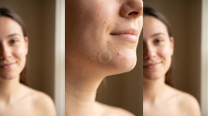 Chin Acne Through Every Life Stage: A 2026 Guide