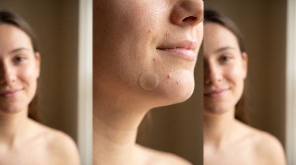 Chin Acne Through Every Life Stage: A 2026 Guide