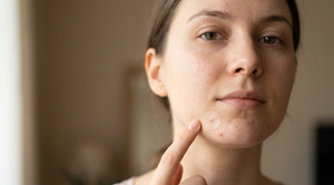 How to Get Rid of Early Stage Acne Fast (2026)