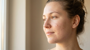 How to Fade Acne Scars: Removal & Prevention 2026