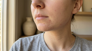 What Does Hormonal Chin Acne Look Like? 2026 Guide