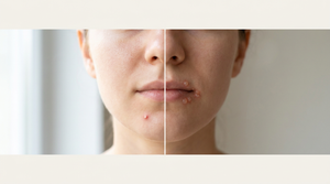 Early Stage Pimple vs Cold Sore: Spot the Difference