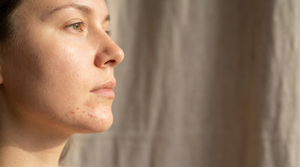 Chin Acne Causes: What Your Breakouts Mean
