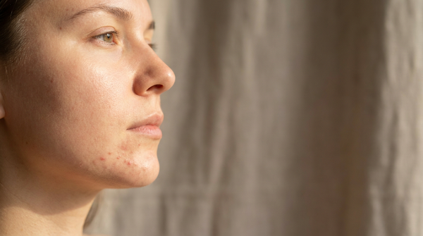 Chin Acne Causes: What Your Breakouts Mean