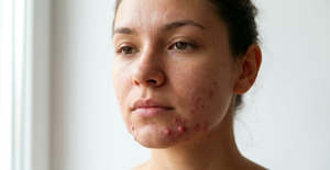 Cystic Acne Photos: How to Recognize and Identify It