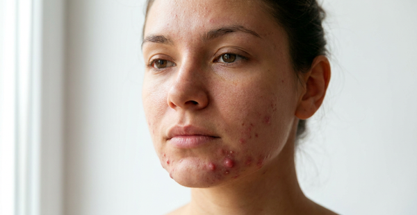 Cystic Acne Photos: How to Recognize and Identify It