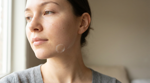 Fastest Way to Get Rid of a Cystic Pimple 2026