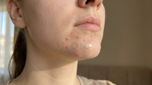Chin Acne Treatment: A Complete Guide (2026)