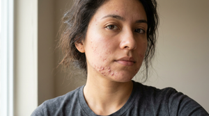 Cystic Acne on Jawline: Why It Happens and How to Treat It