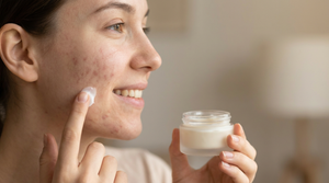 Acne Scars Cream: What Really Fades Marks 2026