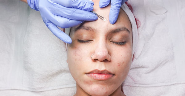 Location-Specific Cystic Acne Tips for Face, Neck, Back, and Body
