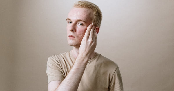 Best Acne Treatment for Cystic Acne: What Actually Works
