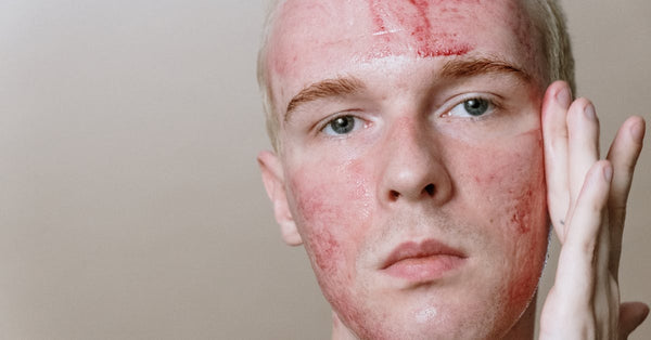 How Long Does Cystic Acne Usually Last? Tips to Heal Faster