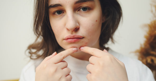 Is It Okay to Pop Cystic Acne? Here's What Experts Say