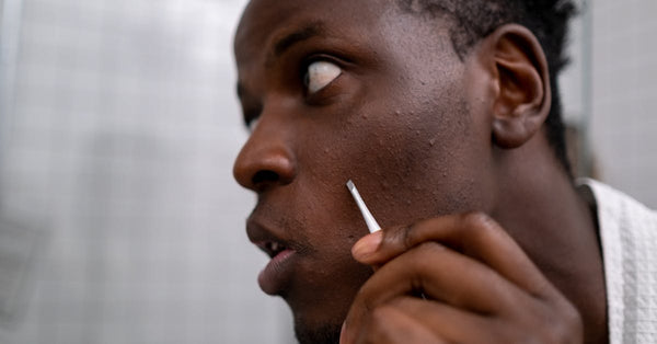 Cystic Acne Treatments That Actually Work: Options Explained