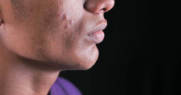How Do You Get Rid of Cystic Acne? Expert Tips That Work