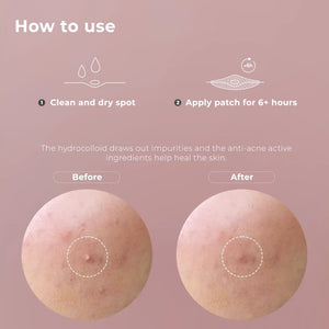 wow patch:  invisible hydrocolloid blemish patch