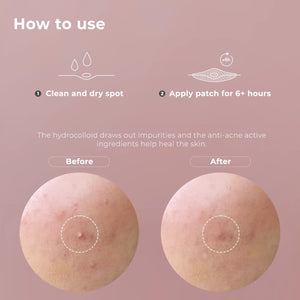 wow patch:  invisible hydrocolloid blemish patch