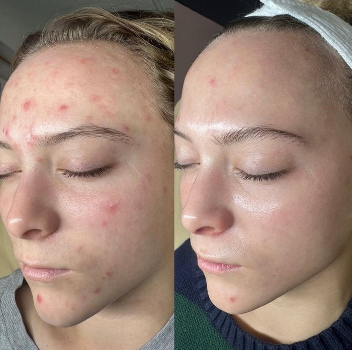 Customer skin before and after using OMMA patches