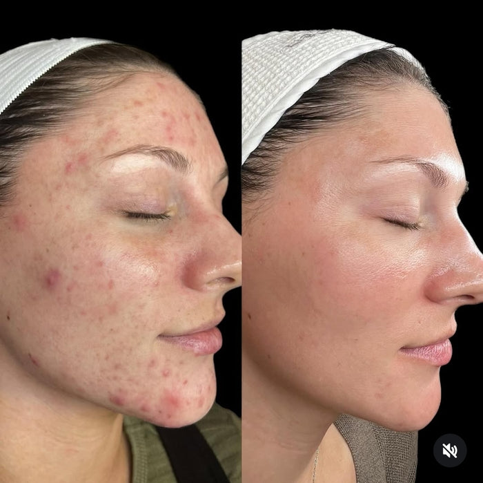 Customer skin before and after using OMMA patches