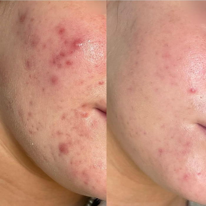 Customer skin before and after using OMMA patches