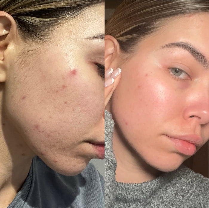 Customer skin before and after using OMMA patches