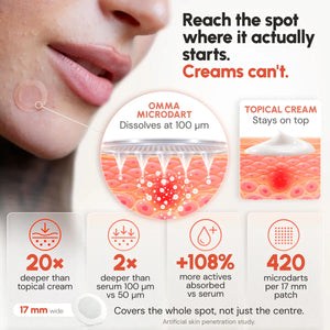 Diagram: OMMA Microdart Acne Patch delivers actives 100 µm under the skin while topical cream stays on the surface