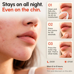 How to apply OMMA Microdart Acne Patch on the chin: clean, dry skin, press the centre for 30 seconds, then the outer ring