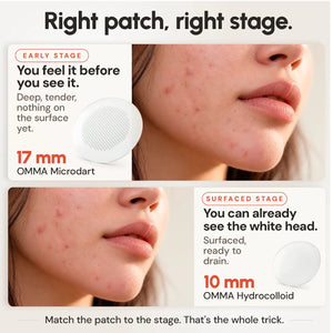 Which acne patch to use: OMMA Microdart Acne Patch for deep early spots, OMMA Hydrocolloid Pimple Patches for spots with a white head