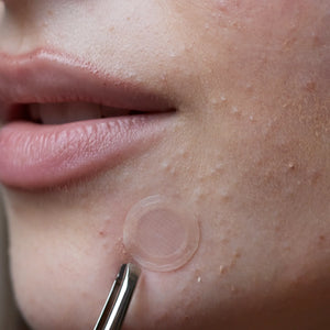 wow patch: microcrystal blemish patch