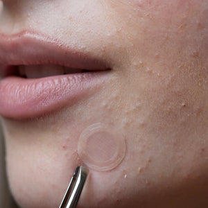 wow patch: microcrystal blemish patch